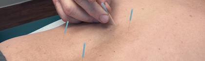 medical acupuncture idaho